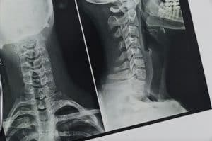 X-ray of a neck injury