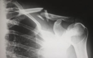 broken collar bone xray