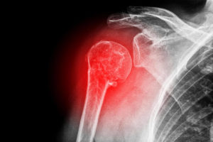 shoulder dislocation xray